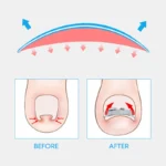 Ingrown toenail corrector kit with brace and precision applicator tool